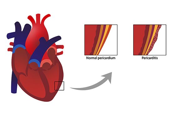 Pericarditis: Causes, Symptoms and Treatment